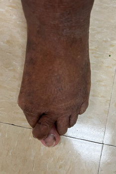 Bunions treatment in process in the Miami-Dade County, FL: Miami (Hialeah, Opa-locka, Coral Gables, Aventura, Ojus, Westview, Golden Glades, Biscayne Park, Brownsville, Gladeview, Surfside, Bal Harbour, Hialeah Gardens, Medley, Miami Springs, Miami Lakes) areas