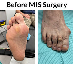 Bunions condition in the Miami-Dade County, FL: Miami (Hialeah, Opa-locka, Coral Gables, Aventura, Ojus, Westview, Golden Glades, Biscayne Park, Brownsville, Gladeview, Surfside, Bal Harbour, Hialeah Gardens, Medley, Miami Springs, Miami Lakes) areas