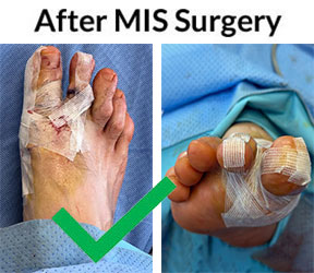 Bunions treatment in process in the Miami-Dade County, FL: Miami (Hialeah, Opa-locka, Coral Gables, Aventura, Ojus, Westview, Golden Glades, Biscayne Park, Brownsville, Gladeview, Surfside, Bal Harbour, Hialeah Gardens, Medley, Miami Springs, Miami Lakes) areas