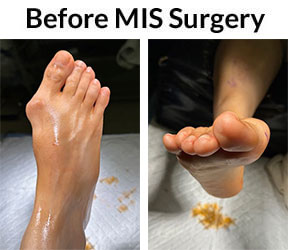 Bunions condition in the Miami-Dade County, FL: Miami (Hialeah, Opa-locka, Coral Gables, Aventura, Ojus, Westview, Golden Glades, Biscayne Park, Brownsville, Gladeview, Surfside, Bal Harbour, Hialeah Gardens, Medley, Miami Springs, Miami Lakes) areas