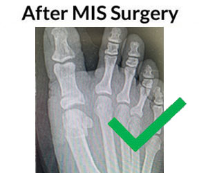 Bunions treatment in process in the Miami-Dade County, FL: Miami (Hialeah, Opa-locka, Coral Gables, Aventura, Ojus, Westview, Golden Glades, Biscayne Park, Brownsville, Gladeview, Surfside, Bal Harbour, Hialeah Gardens, Medley, Miami Springs, Miami Lakes) areas