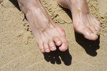Hammertoe Treatment in the Miami-Dade County, FL: Miami (Hialeah, Opa-locka, Coral Gables, Aventura, Ojus, Westview, Golden Glades, Biscayne Park, Brownsville, Gladeview, Surfside, Bal Harbour, Hialeah Gardens, Medley, Miami Springs, Miami Lakes) areas